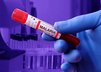 Infected with malaria virus laboratory flask with blood samples.