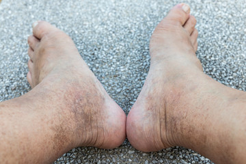 Skin pigmentation on neglected leg of matured male Asian