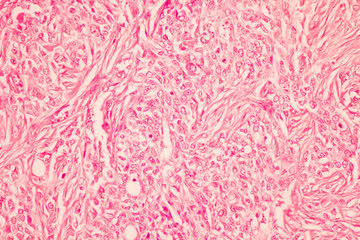 View in microscopic of pathology section ductal cell carcinoma or adenocarcinoma diagnosis by...