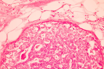 View in microscopic of pathology section ductal cell carcinoma diagnosis by pathologist in...
