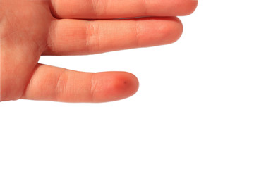 A finger stung by a bee. Female hand with an insect bite, isolated on white background, copy space.