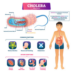 Cholera vector illustration. Labeled infection structure and symptom scheme - obrazy, fototapety, plakaty