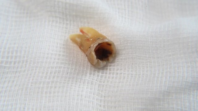 Real time footage of a Damaged molar tooth on a white gauze. Concept of mouth hygine and oral care. Full HD MP4