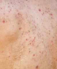 Fototapeta premium Man with acne on his back