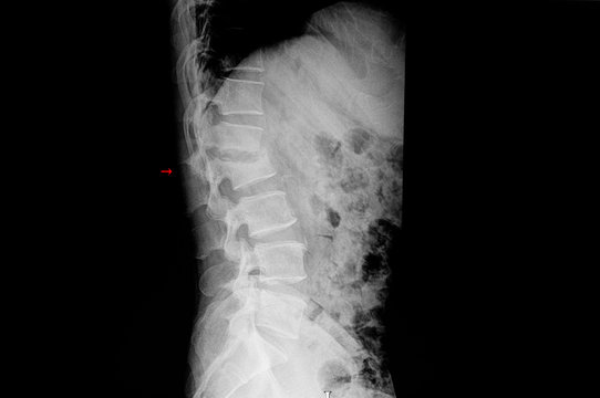 xray film of a patient showing compression fracture of lambar spine