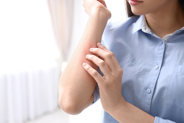 Young woman scratching hand indoors, closeup with space for text. Allergies symptoms