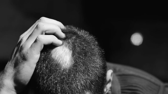 Thoughtful man with bald patches on his head