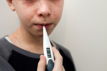 Portrait of sick sad boy child with thermometer having fever suffering from measles or chicken pox with bumps all over face. Contagious child diseases and treatment. - obrazy, fototapety, plakaty