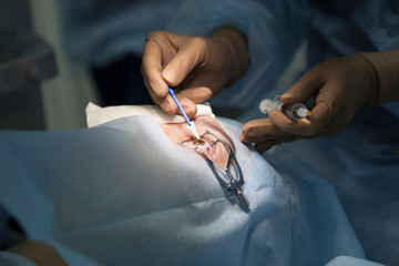 Laser surgery for vision correction