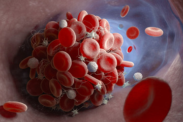 Formation of a blood clot - obrazy, fototapety, plakaty