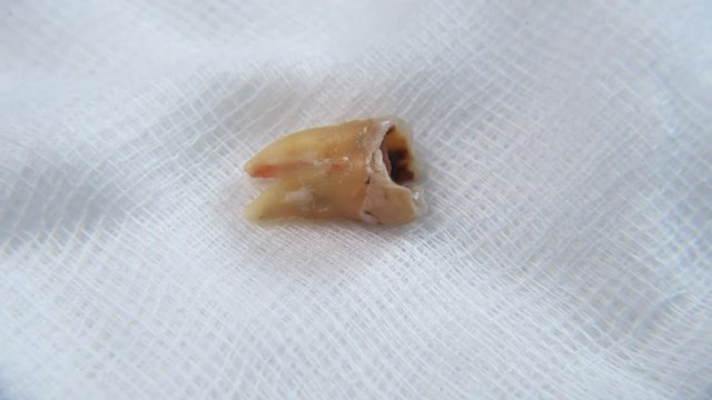 Real time footage of a Damaged molar tooth on a white gauze. Concept of mouth hygine and oral care. Full HD MP4