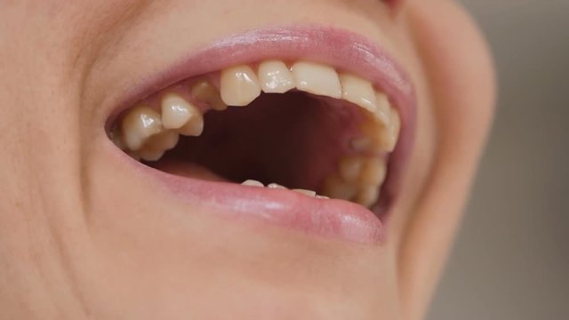 Close-up of the face of an adult woman examining a missing tooth in her mouth.
