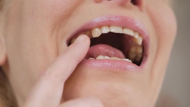 Close-up of the face of an adult woman examining a missing tooth in her mouth.