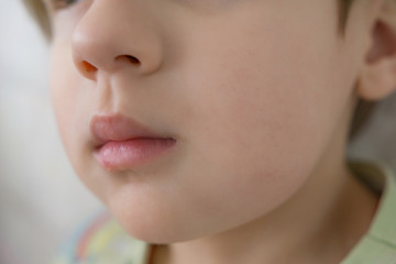 Close-up of a child with toothache, swollen cheek, gangrene. Problems with milk teeth.