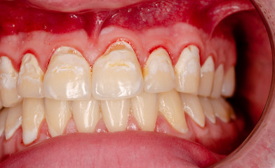 tooth enamel, destroyed by abuse of sugar containing beverages