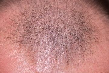 Fototapeta premium Male head with a small amount of hair. Balding head