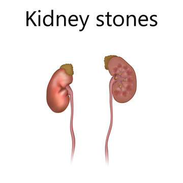 Kidney stones. Urolithiasis, renal lithiasis, nephrolithiasis, clumps of mineral. Realistic anatomy vector illustration.