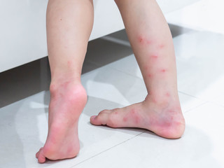 Red blisters on a kid's legs after ants bite (Solenopsis geminata ,tropical fire ant ).