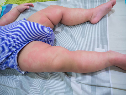 Baby with symptoms of itchy urticaria at legs. Red blister and rash, allergic reactions.