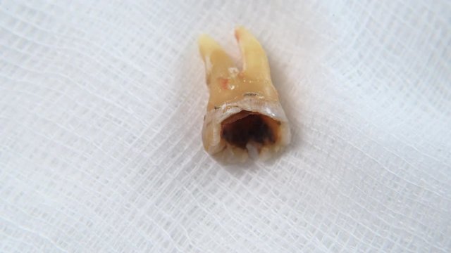 Real time footage of a Damaged molar tooth on a white gauze. Concept of mouth hygine and oral care. Full HD MP4