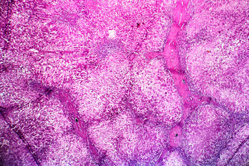 Histopathology of alcoholic hepatitis, light micrograph, photo under microscope