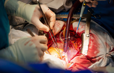 Surgical team operating a patient in an operation theater. Surgeon at work in the hospital. Medicine doctor. Cardiac surgery. Heart transplantation. Surgical equipment and instruments.