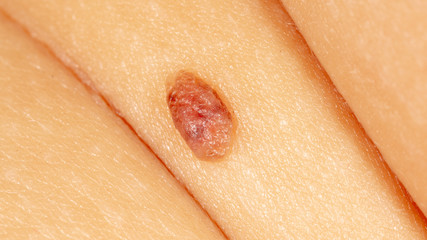 Birthmark on human skin