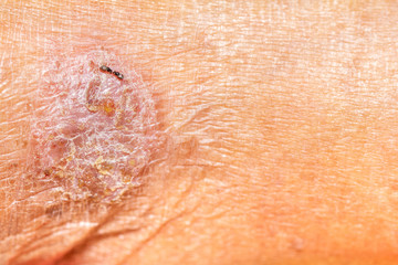 Fototapeta premium Close up blisters of the old man's ,feet Infection of the outer epidermis. Skin diseases