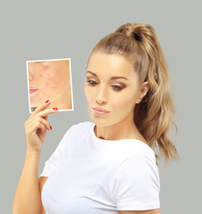 Post-Acne Marks /Treating Acne Scars.Acne Scar Removal
