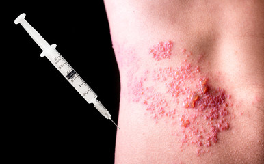 Raised red bumps and blisters caused by shingles on skin and injection needle
