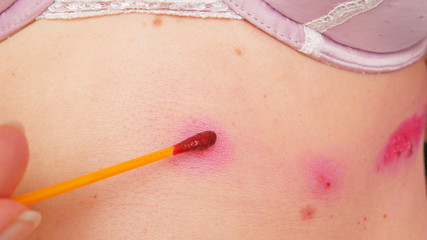 skin rash treatment on woman body. Shingles, Disease, Herpes zoster, varicella-zoster virus. skin...