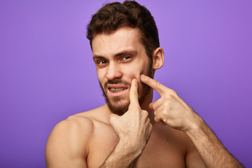 attractive man having problems with his face, guy trying get rid of the pimples. close up shot. treatment of pimples