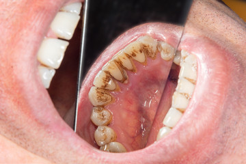 human teeth with smoking plaque and tartar. Close-up macro in dental clinic. Hygiene concept