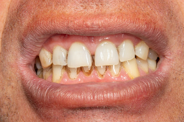 human teeth with smoking plaque and tartar. Close-up macro in dental clinic. Hygiene concept