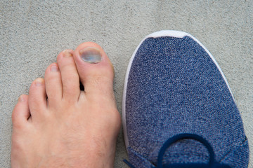 uncomfortable shoes. nail fungus. healthy feet. finger disease. hematoma. toe injury. bruise...