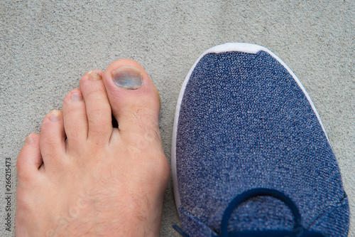 Cefalohematoma Download
