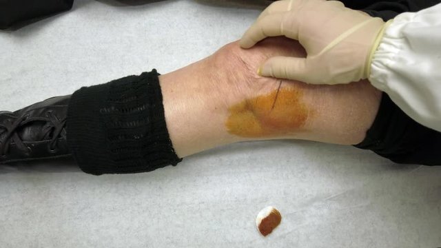 Orthopedic doctor performs limb infiltration with hyaluronic acid for problems related to the kneecap and meniscus of the left leg in a middle-aged patient