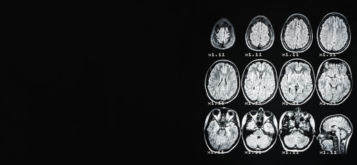 Banner. MRI of the brain of a healthy person on a black background with gray backlight. On the left place under the advertising inscription.