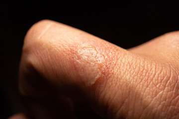 Burning wound of forefinger in detailed macro image. Detail of injury by fire or hot iron.