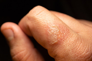 Burning wound of forefinger in detailed macro image. Detail of injury by fire or hot iron.