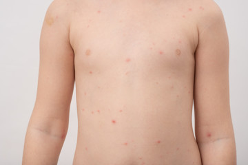 Fototapeta premium Chickenpox, also known as varicella, is a highly contagious disease caused by the initial infection with varicella zoster virus