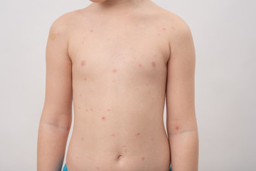 Fototapeta na wymiar Chickenpox, also known as varicella, is a highly contagious disease caused by the initial infection with varicella zoster virus