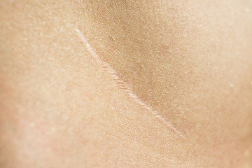Close-up, beautiful surgical scar on the skin after appendectomy  - obrazy, fototapety, plakaty
