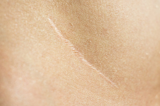 Close-up, beautiful surgical scar on the skin after appendectomy 