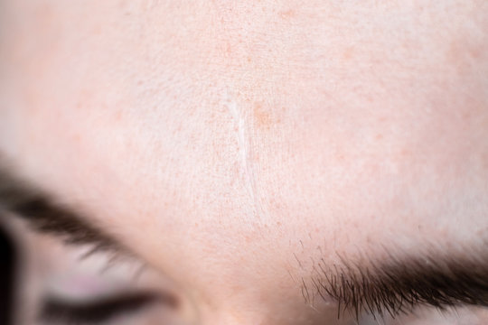 an old white scar on a man's face close up