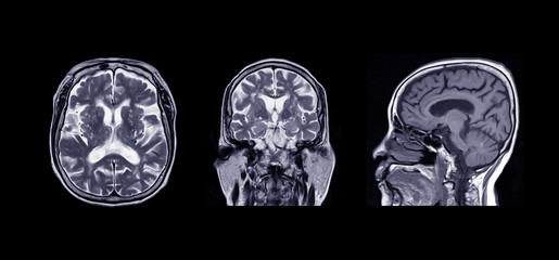 Comparison MRI of the brain Axial, Coronal , sagittal plane  for detect a variety of conditions of the brain such as cysts, tumors, bleeding, swelling, developmental and structural abnormalities.