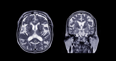 Comparison MRI of the brain Axial and Coronal  plane for detect a variety of conditions of the...
