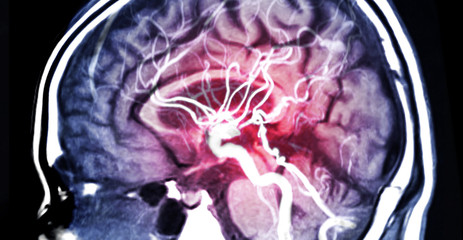 MRA Brain or Magnetic resonance angiography (MRI)  of Vessel in the brain sagittal view for...