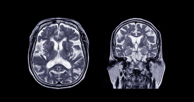 Comparison MRI of the brain Axial and Coronal  plane for detect a variety of conditions of the brain such as cysts, tumors, bleeding, swelling, developmental and structural abnormalities, infections.
