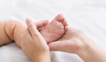 Mother holding tiny baby foot with measles rash - obrazy, fototapety, plakaty